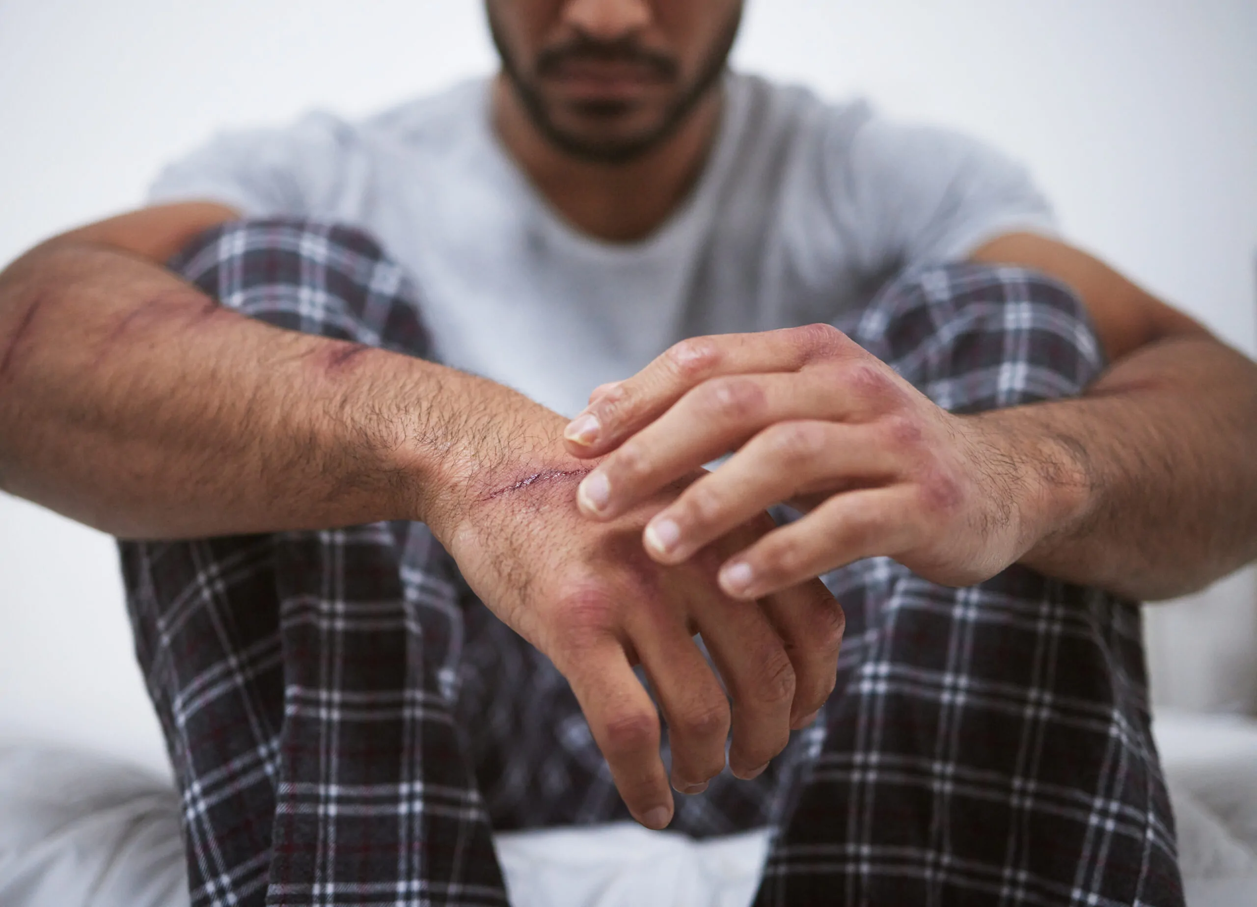Treating PTSD from Car Accidents in Florida